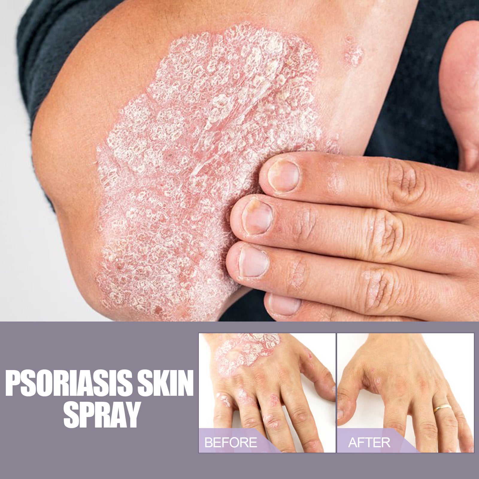 Eczema and Psoriasis Itching Relief Spray