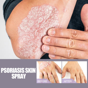 Eczema and Psoriasis Itching Relief Spray